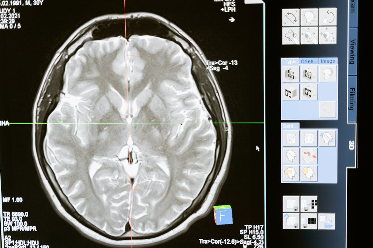 Brain injury x-ray result